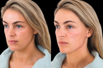 Cheek Fillers for Natural Lift Best Plastic Surgeon in Dubai