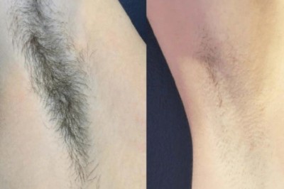 Laser Hair Removal Treatments in Dubai for Men: What You Should Know
