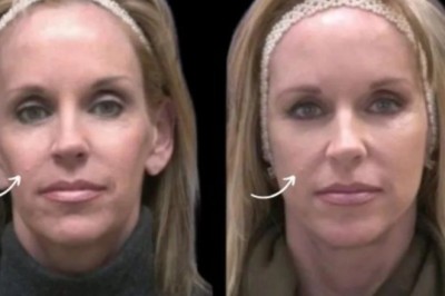 Best Doctors in Dubai for Sculptra Smile Correction