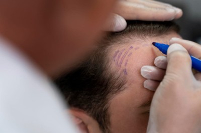 Confidence Starts with Hair Replacement in Dubai Treatments