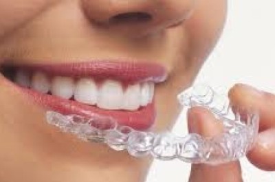 Aligners In Dubai Discreet Orthodontic Solutions For Perfect Smiles