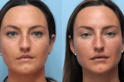 Best Plastic Surgeon in dubai for thread lift for Non-Surgical Face Lifting