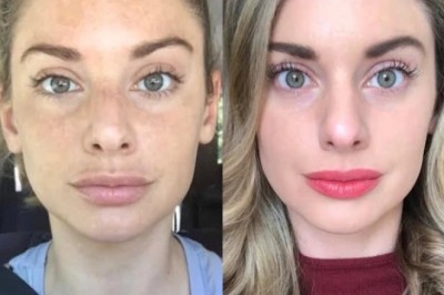 Comprehensive Radiofrequency (RF) Microneedling Treatments in Dubai