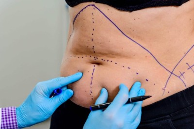 Mommy Makeover Procedures Blending Surgery with Personalized Aesthetic Care