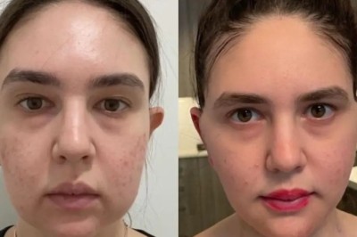 Best Buccal fat removal Surgeon in Dubai How to Choose