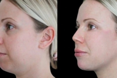 Jawline Fillers and Self-Esteem Boosts at the Best Aesthetic Clinic in Dubai