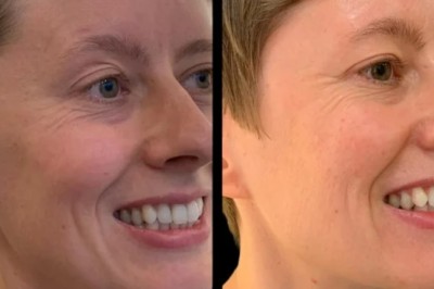 Profhilo Excellence Led by Best Plastic Surgeons in Dubai