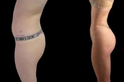 How J-Plasma Treatment in Dubai Improves Skin Texture and Tone