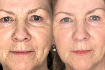 Best Aesthetic Clinic in Dubai for Long-Lasting Profhilo Results