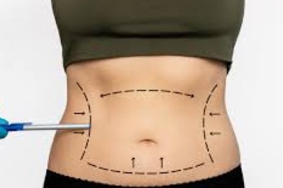 Mini Tummy Tuck Dubai: Combining with Liposuction for Best Results