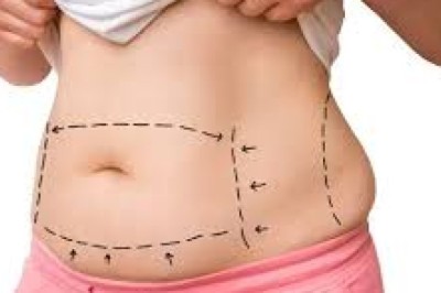 Tummy Tuck Surgery Dubai Results Timeline