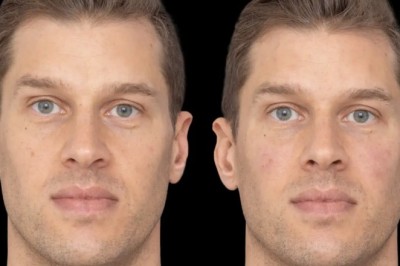 The Journey of Getting Jawline Fillers: Best Doctors in Dubai Guide