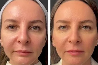 Hydration Mesotherapy – Best Aesthetic Clinic in Dubai