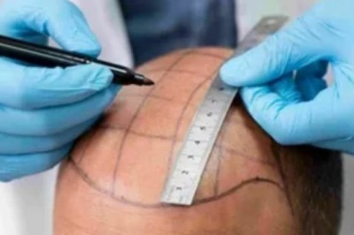 Saudi Excellence: Why Vision 2030 is Driving Medical Excellence in Riyadh’s Hair Clinics