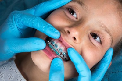 Understanding Dental Braces in Dubai: A Complete Guide for Beginners