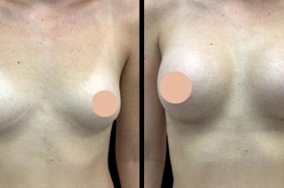 Best Breast Augmentation Surgeon in Dubai: Complete Procedure Overview