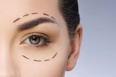 Brighter Eyes with Upper Blephroplasty in Jeddah