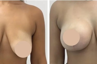 Best Breast Reduction Surgeons in Dubai for Customized Surgical Plans