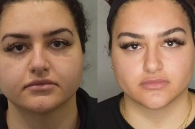 Long-Term Facial Aging Explained by the Best Buccal fat removal Surgeons in dubai