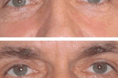 Prevent Eye Bags Early | Best Eye bag removal Surgeons in dubai