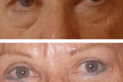 Eye bag removal in Dubai: Aftercare tips