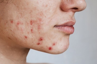 Acne Treatment In Dubai: Advanced Skincare Options for Clear Skin