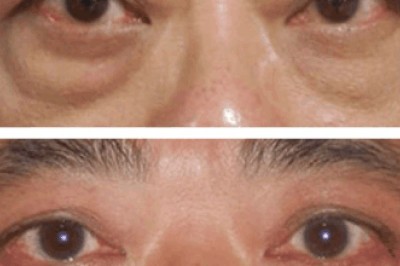 Follow-Up Visits | Best Eye bag removal Surgeons in dubai