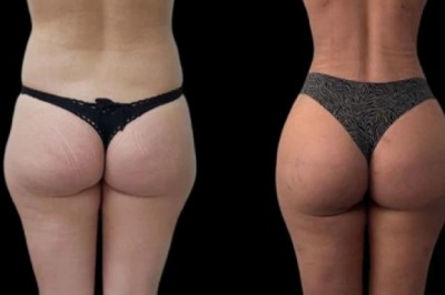 How Best Doctors in Dubai Perform J-Plasma Treatment