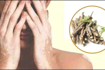 Best Vitiligo Treatment in Ayurveda in Hindi | Kayakalp Global Vitiligo Specialists