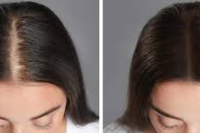 What Makes Hair Transplant Surgery Los Angeles a Smart Choice for Long-Term Hair Restoration?