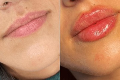 Juvederm Lip Fillers at the Best Aesthetic Clinic in Dubai
