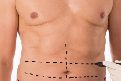Who Should Consider Liposuction in Islamabad for Safe Results