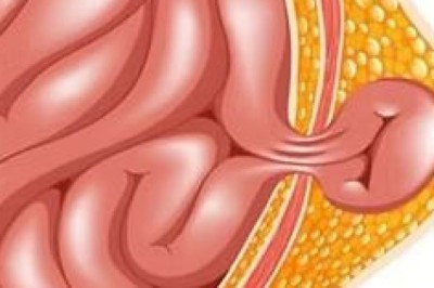 Expert Hernia Surgery Singapore — Modern Solutions for Faster Recovery