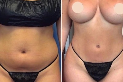 J-Plasma Treatments in Dubai: Smooth and Tight Skin Made Possible