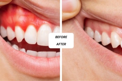 Cosmetic Dentistry In Dubai: Transformative Smile Makeover Treatments for Whiter Teeth, Perfect Alignment, and Aesthetic Beauty