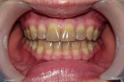 Dental Fillings Near Me in Diamond Bar for Lasting Tooth Protection