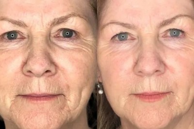 What Expertise Supports Profhilo by Best Doctors in Dubai?