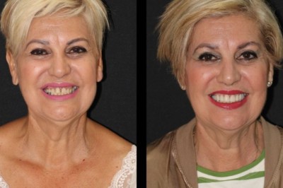 Blanqueamiento Dental en Hospitalet de Llobregat Dientes Más Blancos y Brillantes