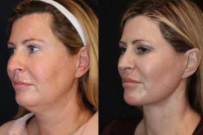 Skin Tightening Treatments in Dubai: Transform Your Skin Without Surgery