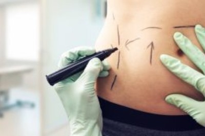 Abdominoplasty Dubai: Step Into a New You