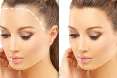 Overcoming Baldness Through Saudi Arabia Hair Transplants