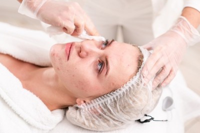What Types of Pimples Treatment in Dubai Exist?