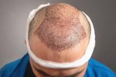 Hair Transplant in Dubai: Best Time of Year for the Procedure