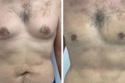 Common Mistakes People Make When Dealing with Gynecomastia in Dubai