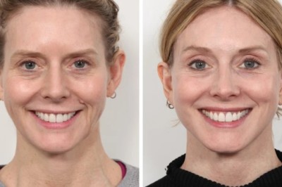 Thread lift Treatment in Dubai for Skin Tightening Trends