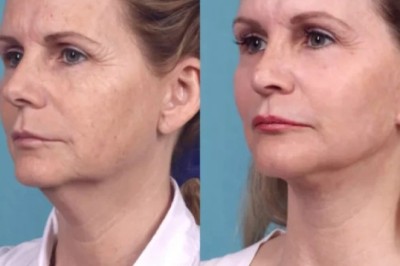 Chemical Peel Treatments in Dubai for Skin Perfection