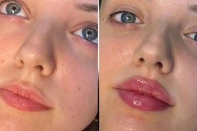 Jawline Fillers Treatments in Dubai for Definition