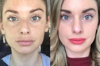 Radiofrequency (RF) Microneedling in Dubai Long-Term Skin Benefits
