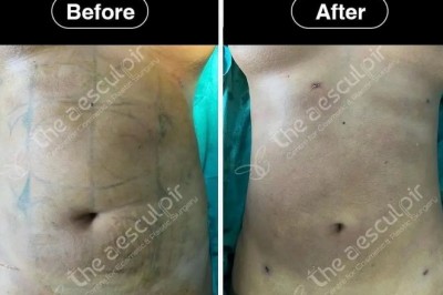 Discover Affordable Liposuction Surgery Cost in India with the Best Plastic Surgeon at Theaesculpir