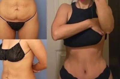 The Best Tummy Tuck Surgeons in Dubai: What to Expect During Your Consultation